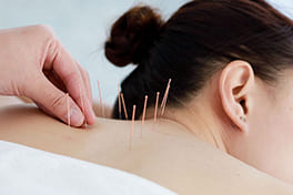 Acupuncture